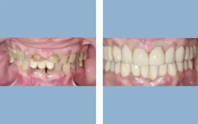 Before and After